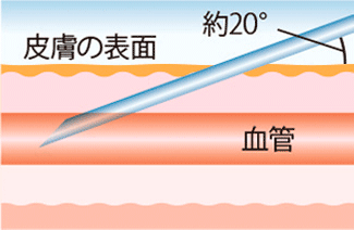 血管への針の刺し方
